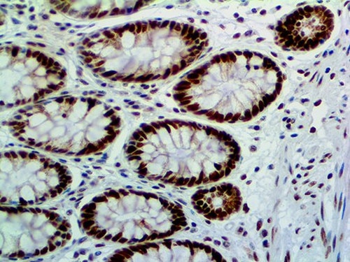 MSH6 Antibody Immunohistochemistry on a FFPE Colon Carcinoma Tissue